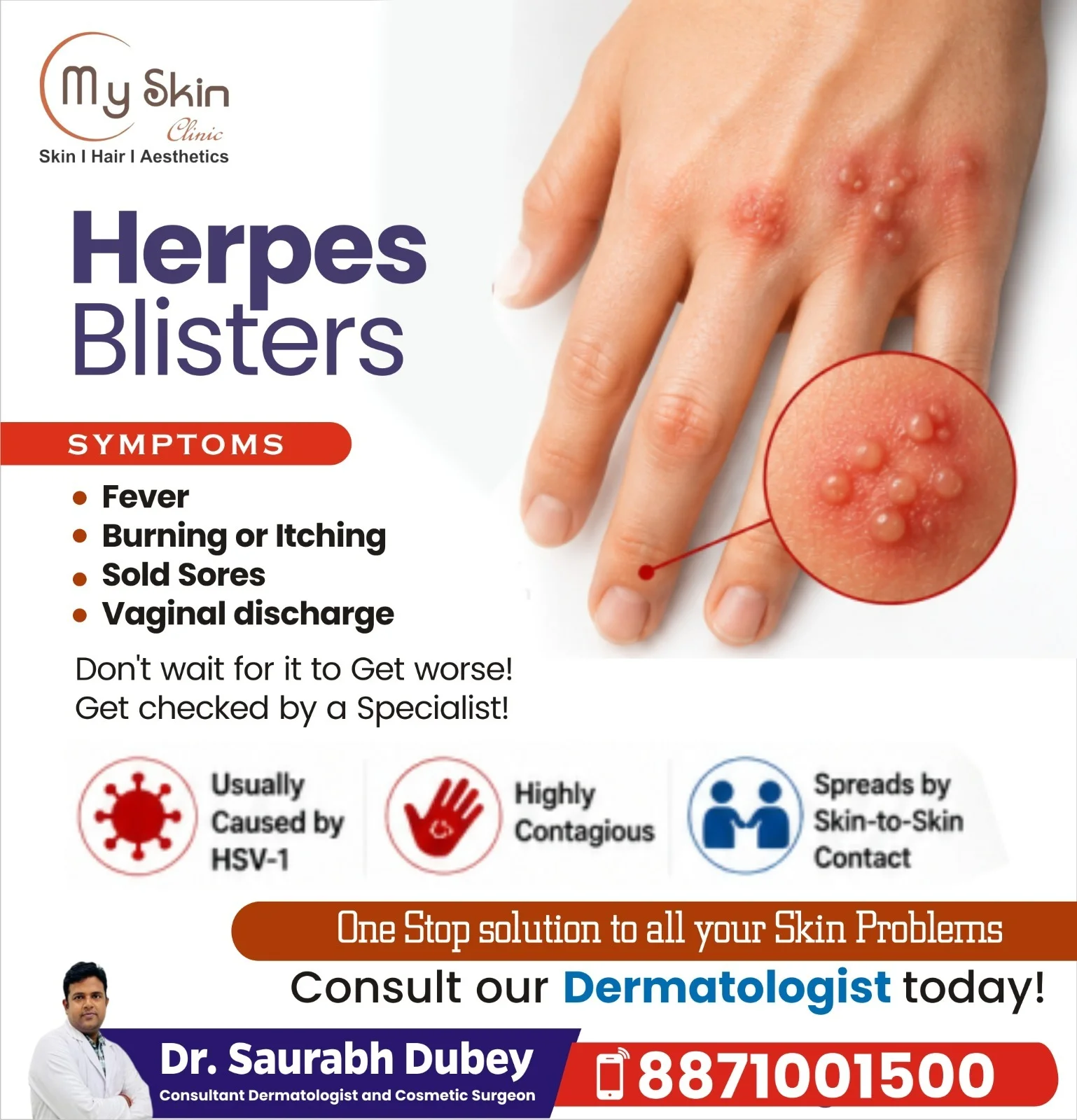 Herpes Blisters Treatment in Indore